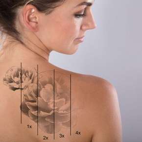 PicoSure Laser for Tattoo Removal Charleston SC