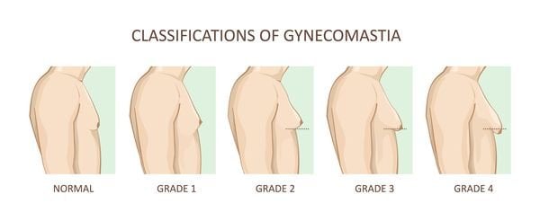 40% of Breast Reduction Surgeries Are Performed on Men