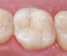 Tooth-Colored Fillings.