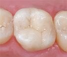 Tooth-Colored Fillings in row of teeth, Royal Palm Beach, FL dentist