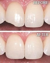 Tooth Bonding | Dentist in Santa Fe and Los Alamos, NM | Sonrisa Dental