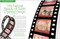Dentist In Worcester | Dental Fillings