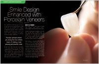 Medina Veneers | Lodi Veneers