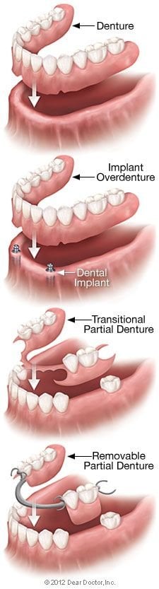 Removable denture types. dentures Olympia Fields, IL dentist