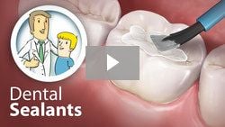 Dental sealants video, dentist Houston, TX