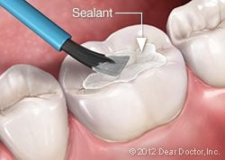 Dental Sealants.