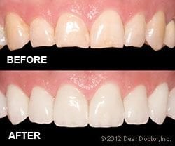 Porcelain veneers treatment Girvin FL 