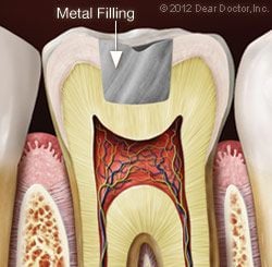 tooth diagram with Metal Filling Bellmore, NY