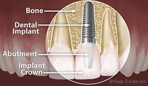 Dental Implant diagram showing implant placed in gum. Montville, NJ dental implants