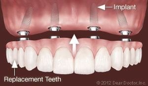 Dental Implants San Diego Replace All Teeth