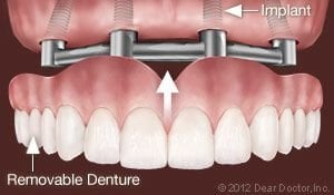 Dental Implants Support Removable Dentures.