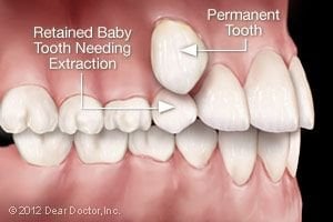 illustration of child's mouth with permanent tooth coming in above baby tooth, tooth extractions Marysville, OH dentist