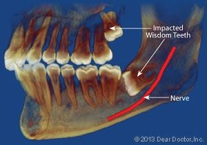 xray of jaw showing impacted wisdom teeth and nerve. Freehold, NJ Wisdom teeth removal Elizabeth, NJ