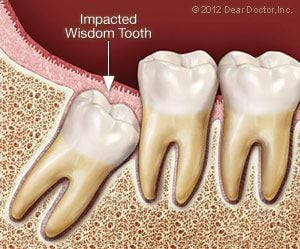illustration showing Impacted wisdom tooth, Elizabeth, NJ wisdom tooth extraction Freehold, NJ