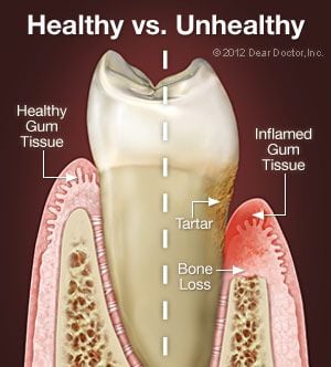 Gum Disease Treatment | Dentist In Cambridge, ON | Woodland Park Dental