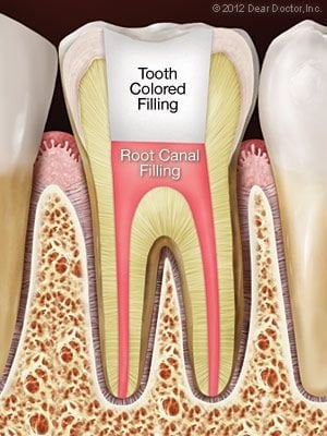 illustration of tooth with filling after root canal Katy, TX dentist