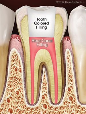 Root Canals | Dentist In Columbia, SC | Smith Family Dentistry