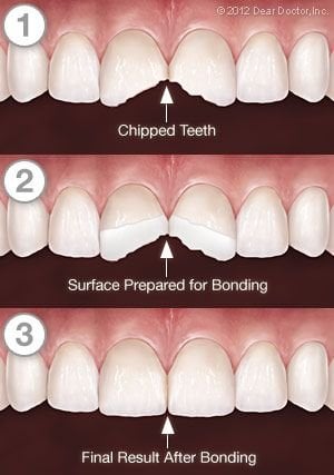 Tooth Bonding Process in Manassas VA