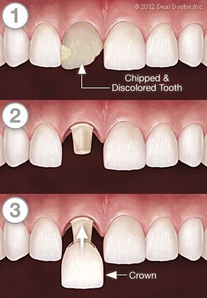 illustration of chipped and discolored tooth being covered by Dental Crowns Perry Hall, MD