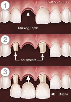 illustration showing steps of missing tooth in mouth being replaced by dental bridge, Royal Palm Beach, FL dentist