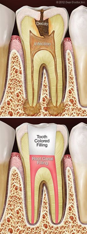 illustration of decayed infected tooth before and after Root canal treatment Laurel, MS