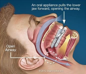 illustration of man's head and internal view of mouth wearing oral appliance for treatment of sleep apnea Washington, DC