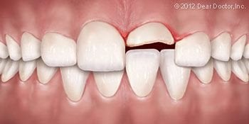 Chipped tooth Dental Emergency Atascadero