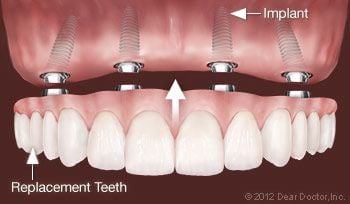 All-on-Four Dentures Stockton, CA | Nu Smile Dental