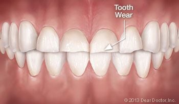 Tooth wear.