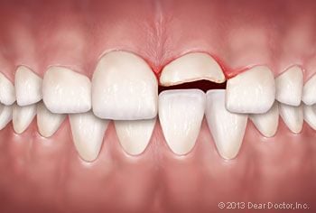 Full Mouth Reconstruction | Dentist in Fremont, CA | Freemont Dental Excellence
