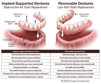 Implant supported fixed dentures vs removable dentures.