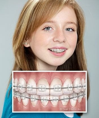 How Metal & Ceramic Braces Are Different