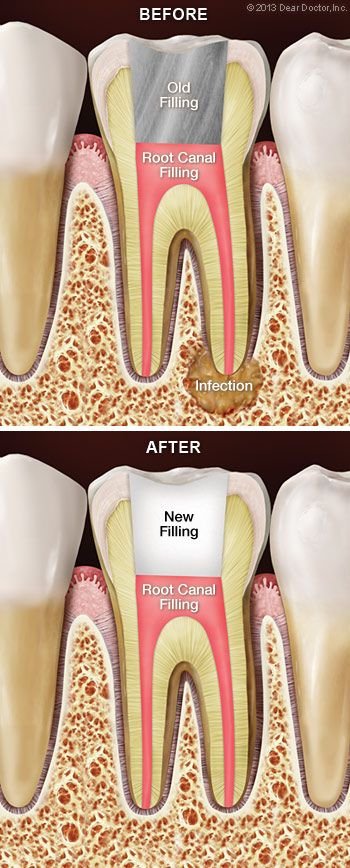 Root Canal Retreatment Appleton Wi Dentist Dental Center The Valley Ltd