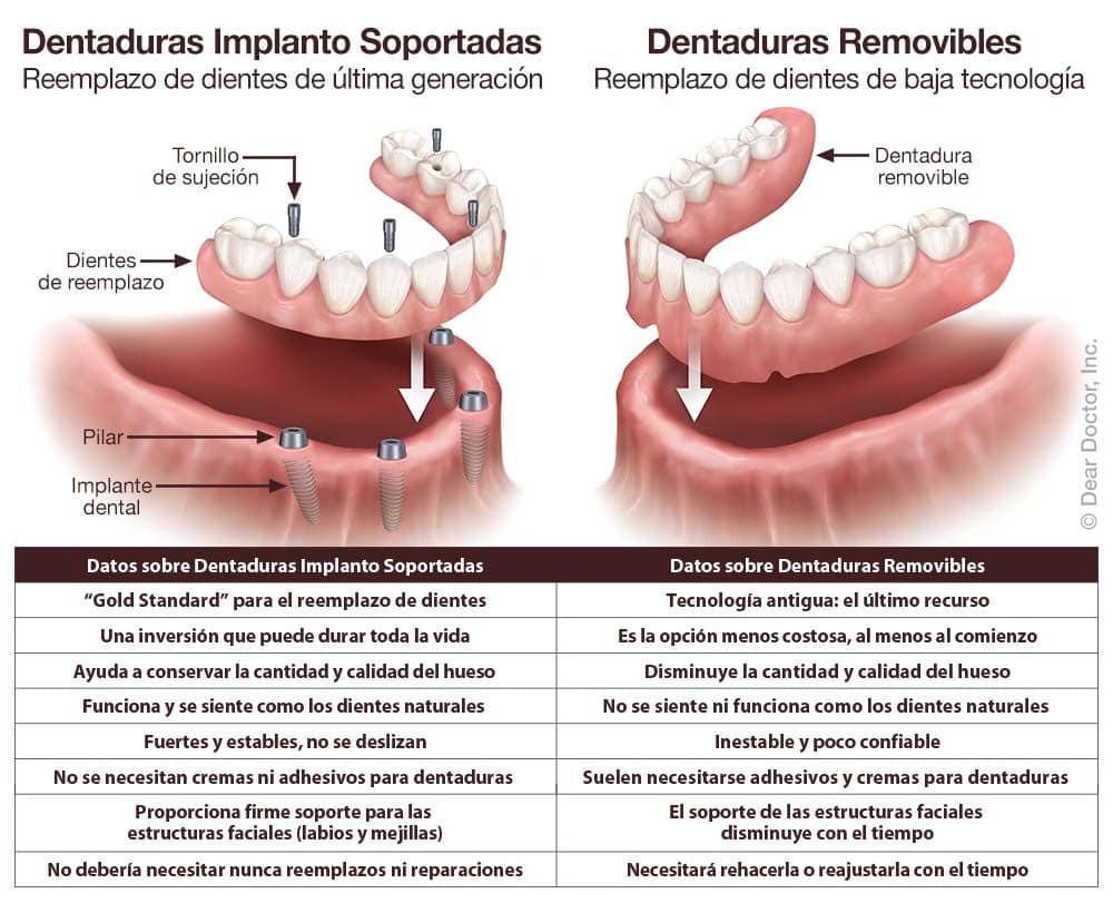 Dentaduras implanto soportadas versus dentaduras removibles.