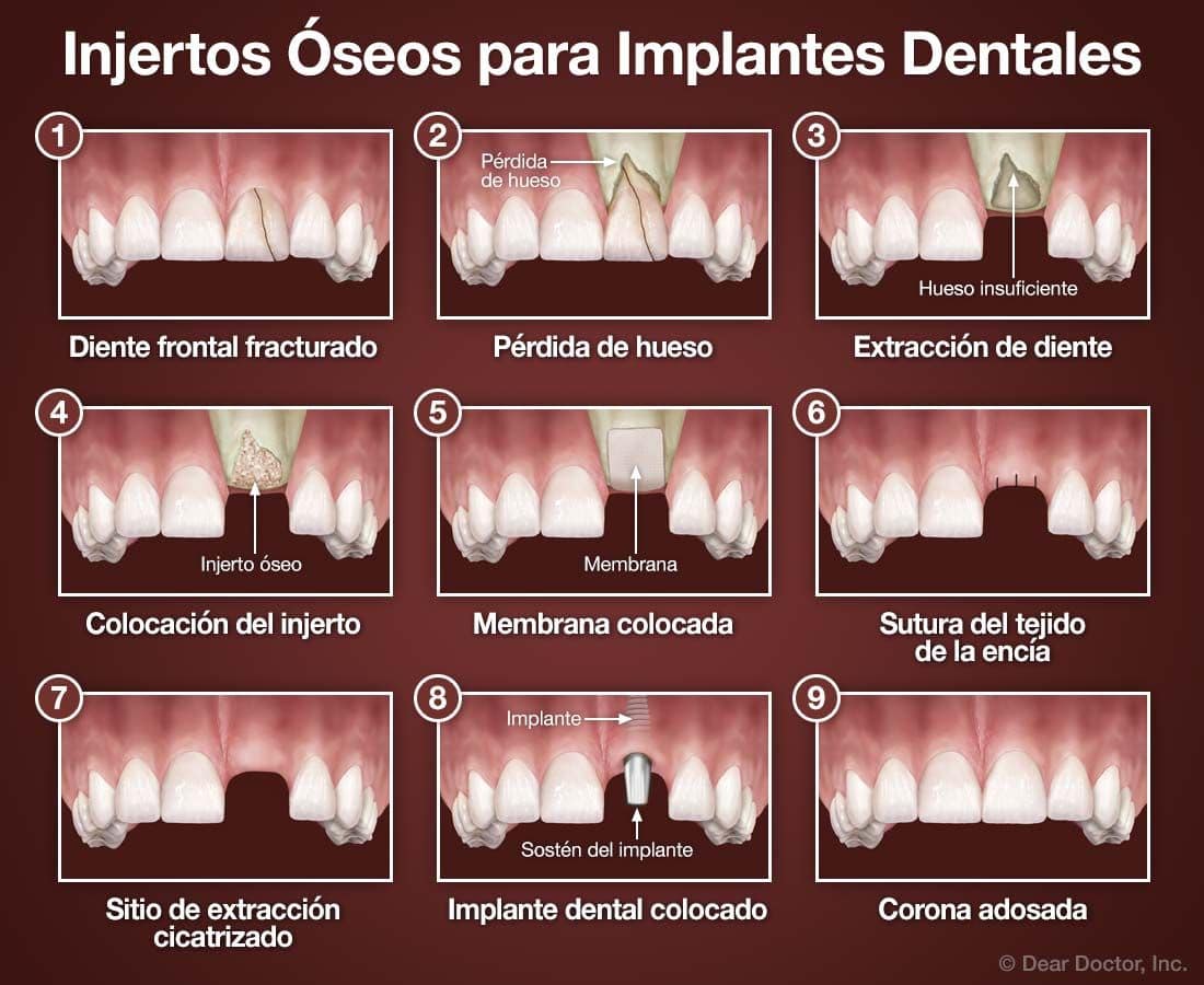 Injertos Óseos para Implantes Dentales.