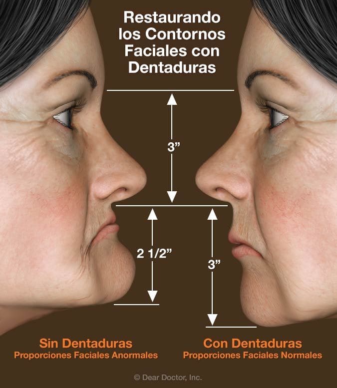 facultativo ángulo Descodificar Dentaduras Removibles | Advanced Smiles Dental, P.A.