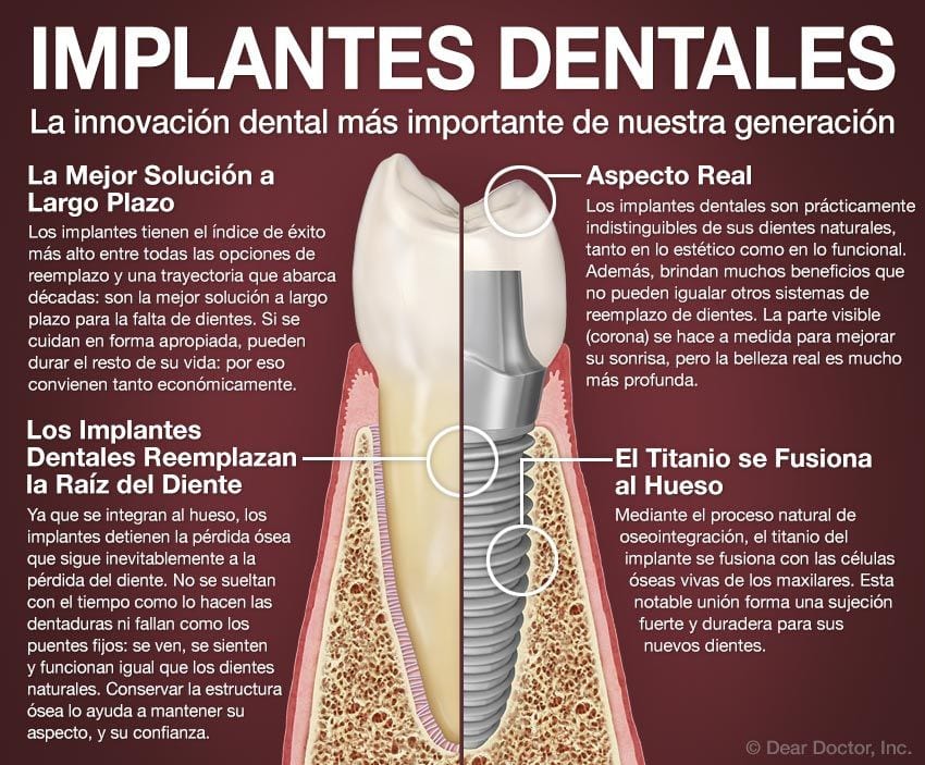 Implantes Dentales.
