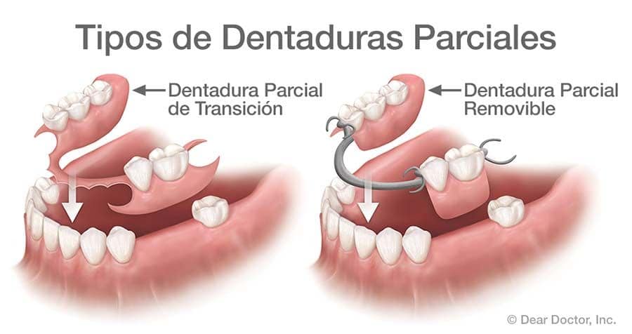 Tipos de Dentaduras Parciales.