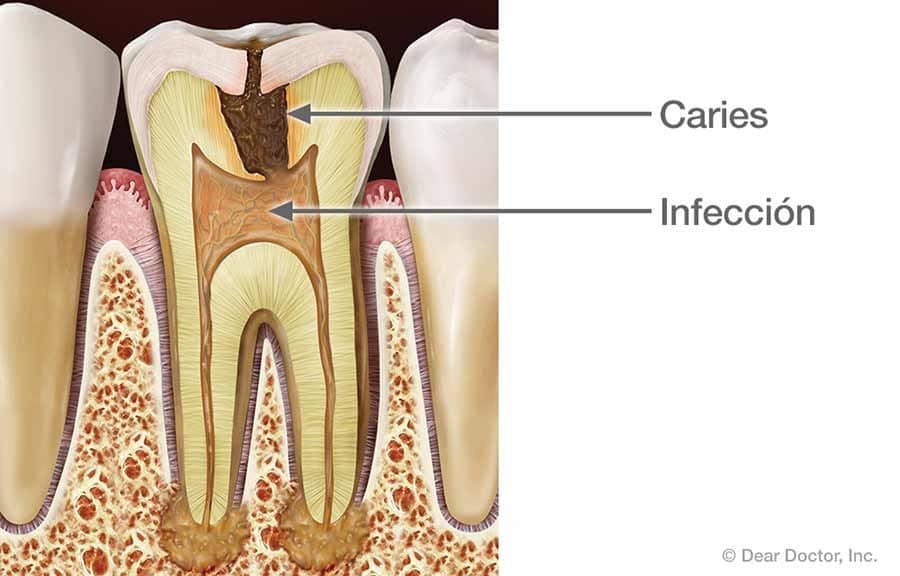 Infección.