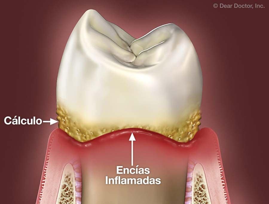 Enfermedad periodontal.