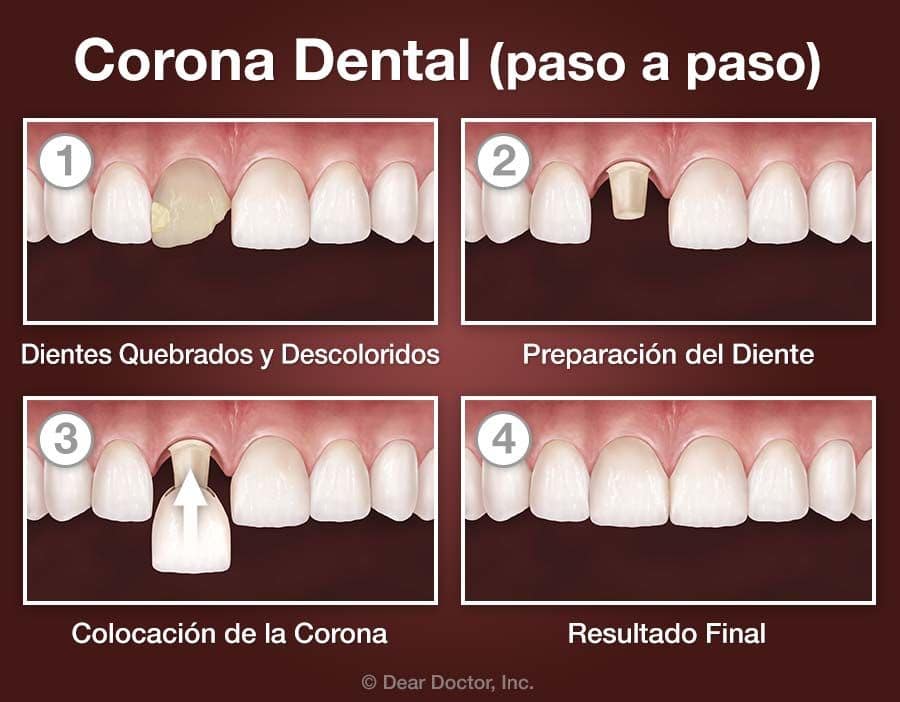 Corona Dental (paso a paso).