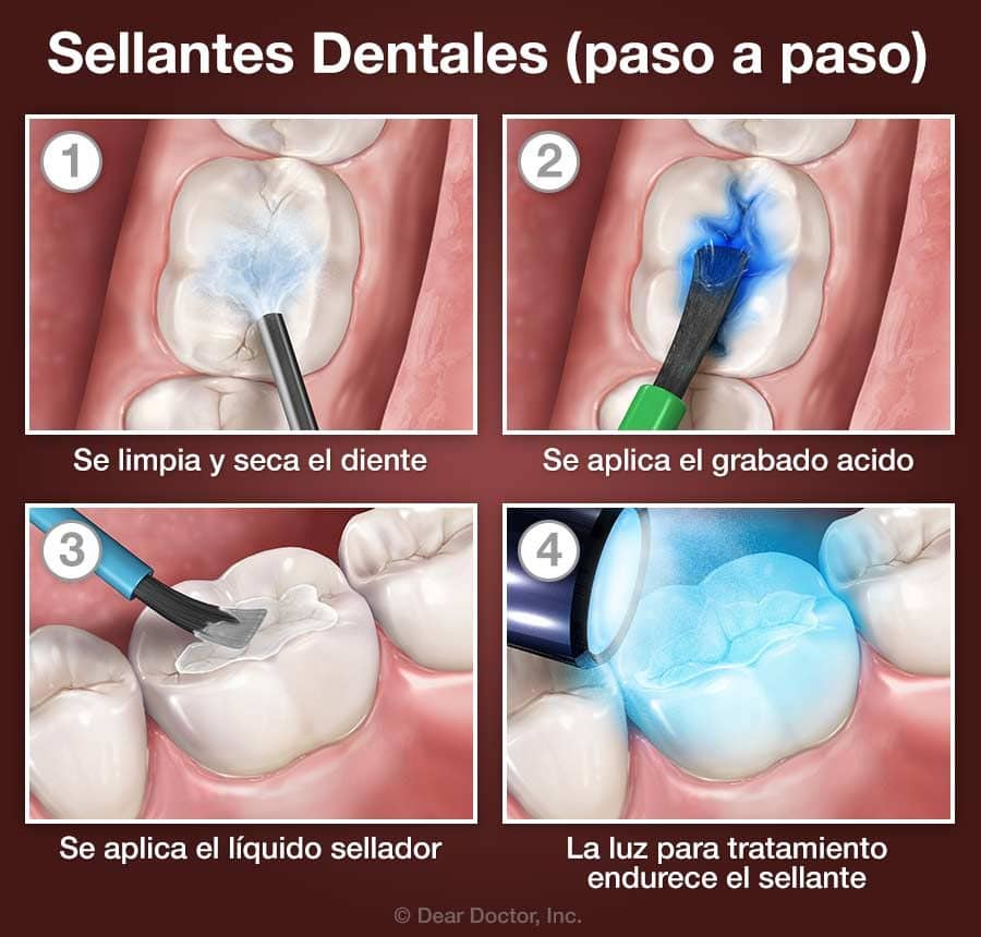 Cómo Usar el Hilo Dental  Advanced Smiles Dental, P.A.