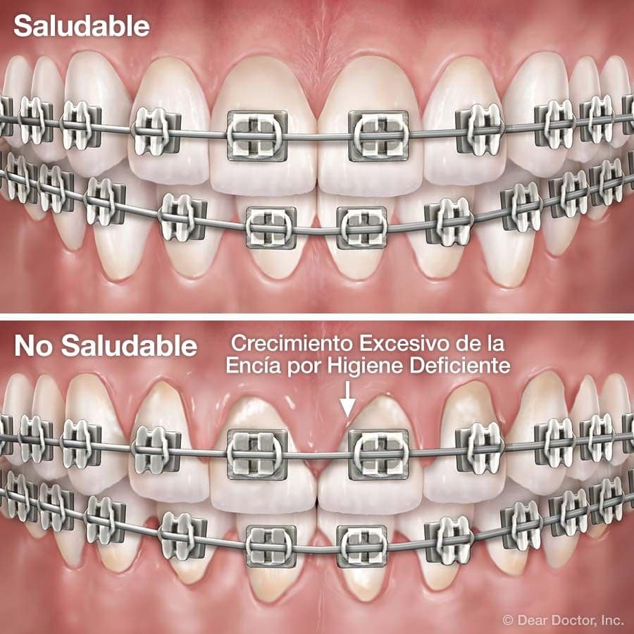 Nominal Completo por otra parte, Ortodoncia e Higiene Dental | Advanced Smiles Dental, P.A.