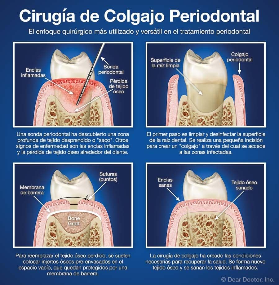Cirugía de Colgajo Periodontal.