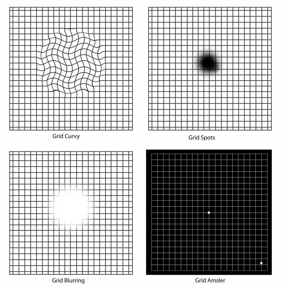 eye examination with an Amsler grid