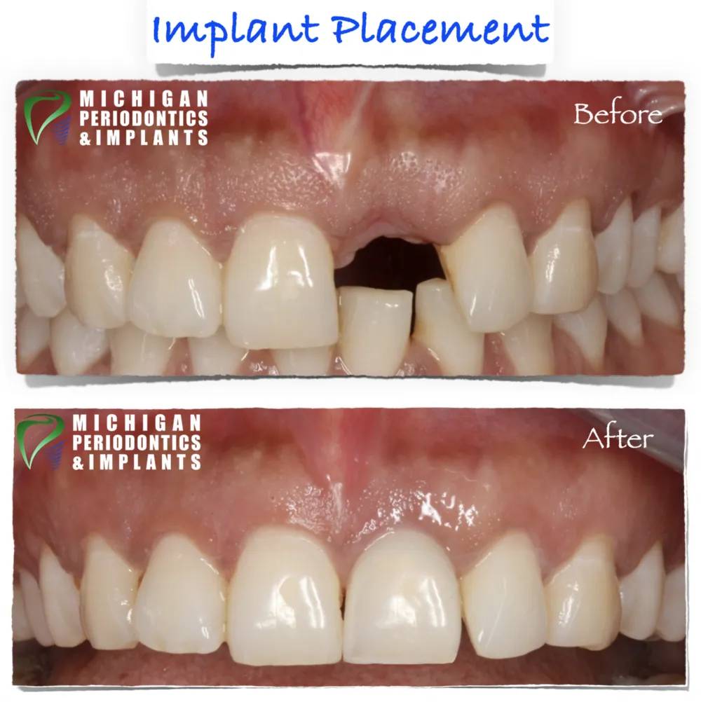 Before & After Dental implants Sterling Heights |Warren MI