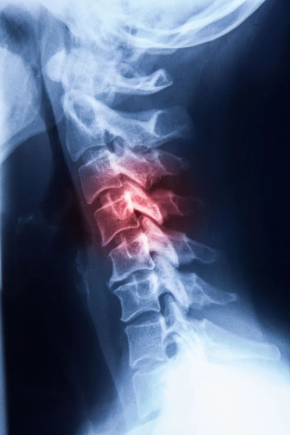 chiropractic/Cervical_Xray.jpg