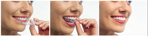 fremont ca invisalign