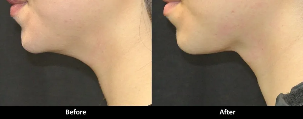 Kybella before and after