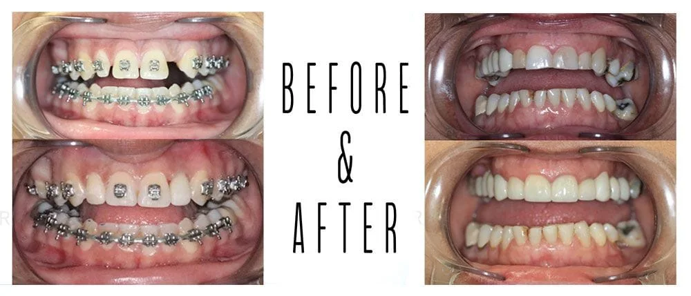 Before and After cosmetic dentistry Cedar Park